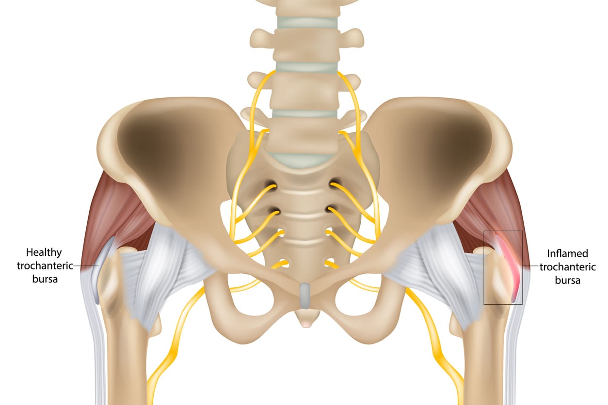How to treat bursitis